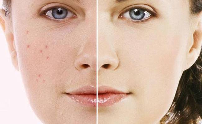 Acne: causas, tipos, sintomas e tratamentos