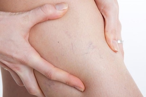 Varizes – O que são, Causas, Sintomas e Tratamentos