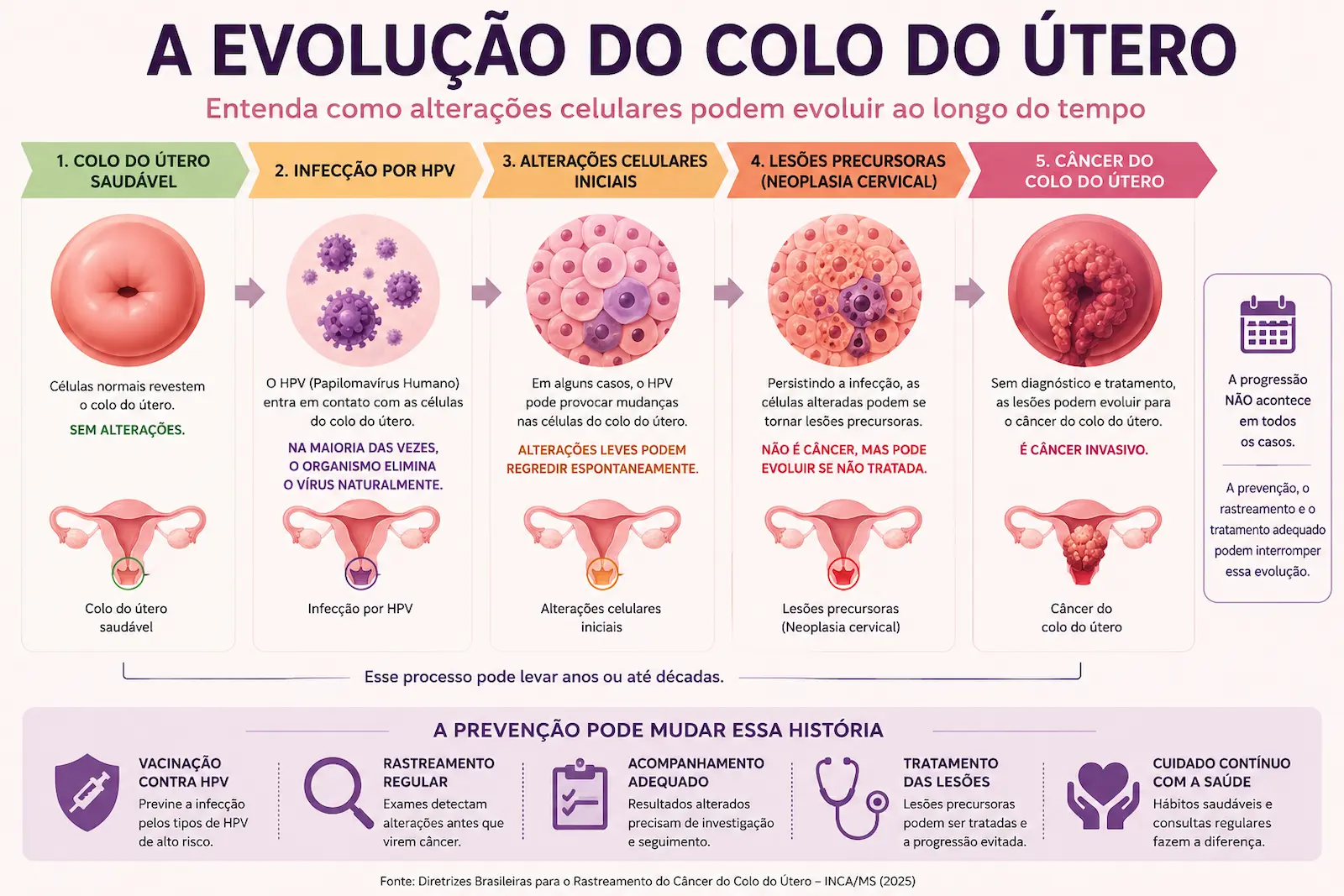 Como o câncer do colo do útero pode se desenvolver Infográfico mostrando a evolução do colo do útero saudável até alterações celulares, lesões precursoras e câncer do colo do útero