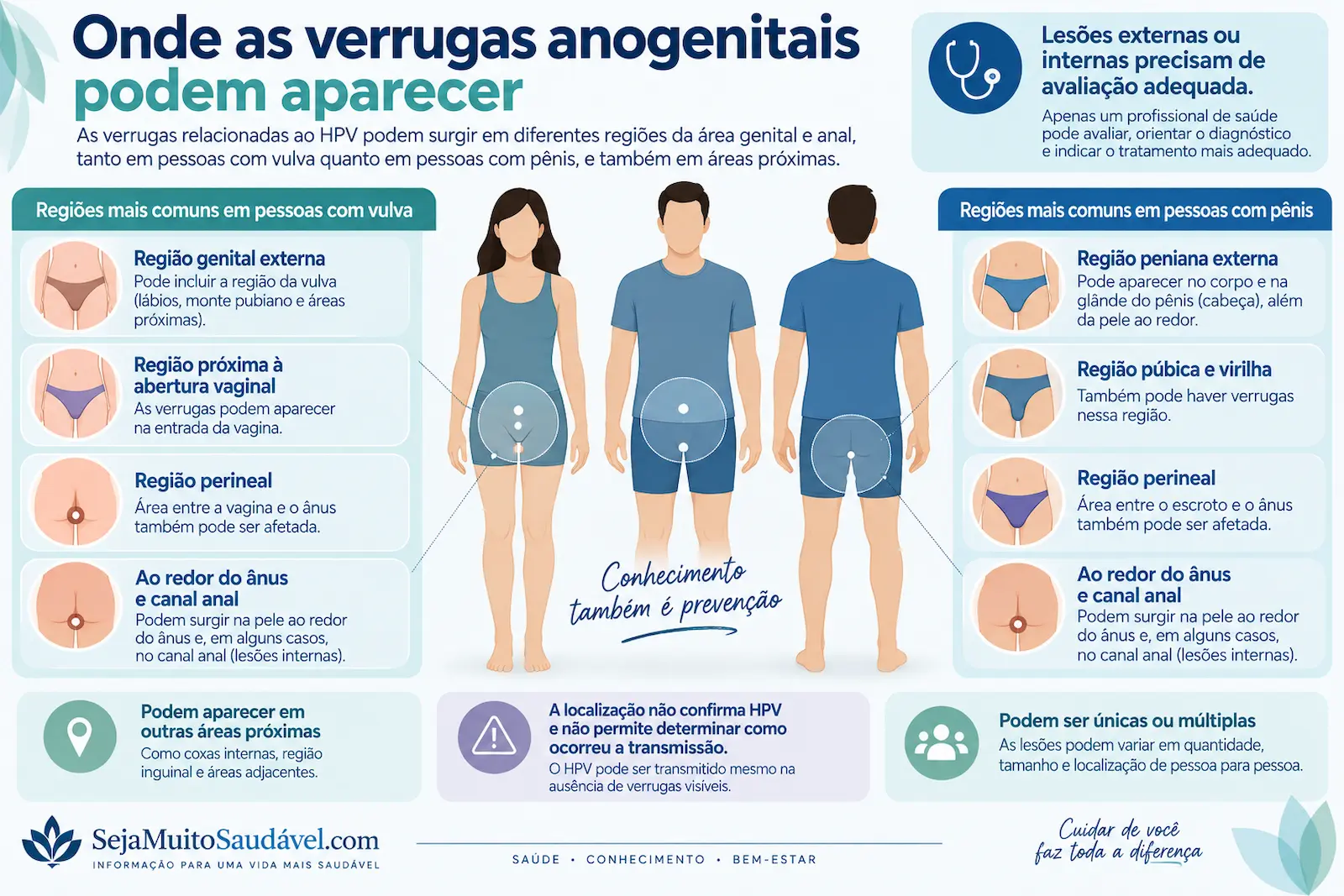 Onde as verrugas genitais podem aparecer Mapa anatômico educativo e não explícito mostrando regiões onde verrugas genitais e anogenitais podem aparecer