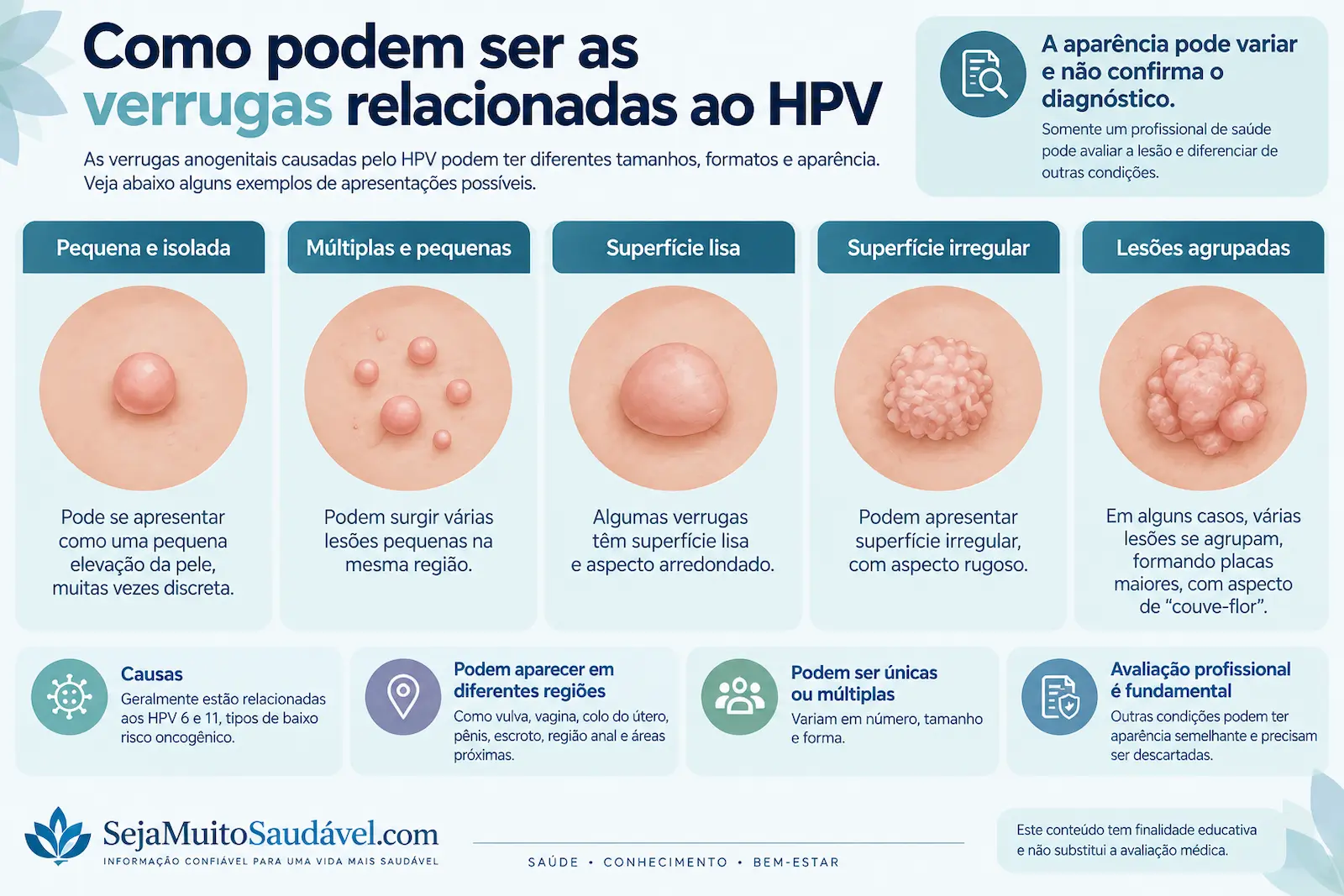 Como podem ser as verrugas genitais relacionadas ao HPV Infográfico educativo mostrando diferentes formas possíveis de verrugas genitais relacionadas ao HPV sem fotografias clínicas explícitas